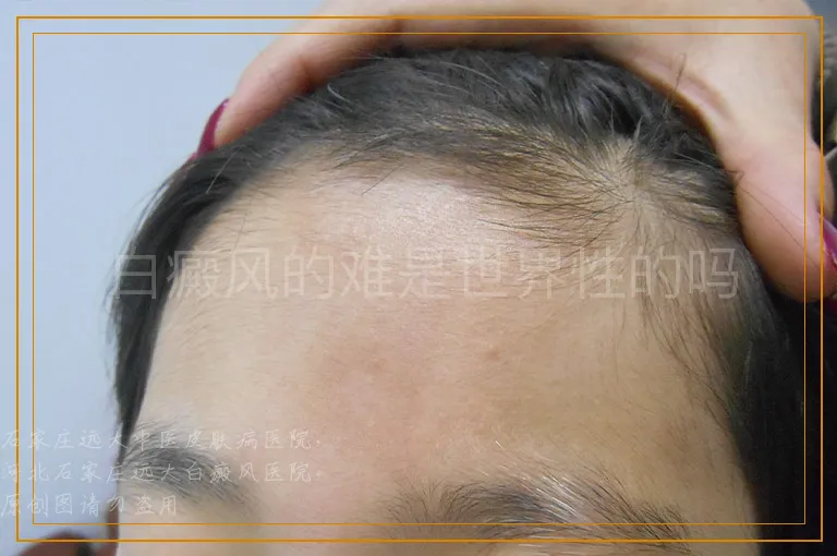 白癜风的难是世界性的吗