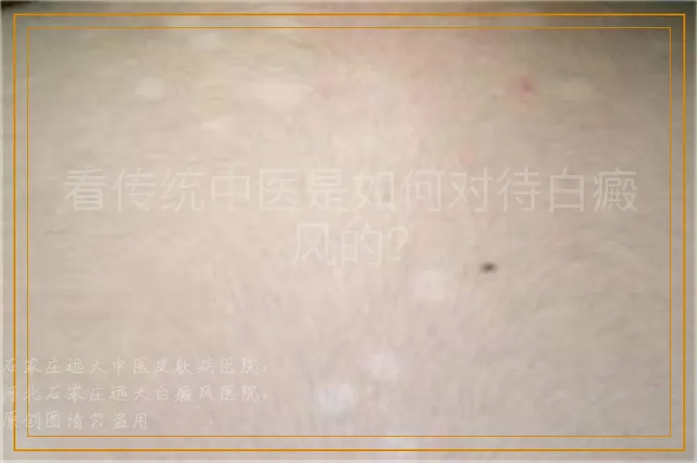 看传统中医是如何对待白癜风的？