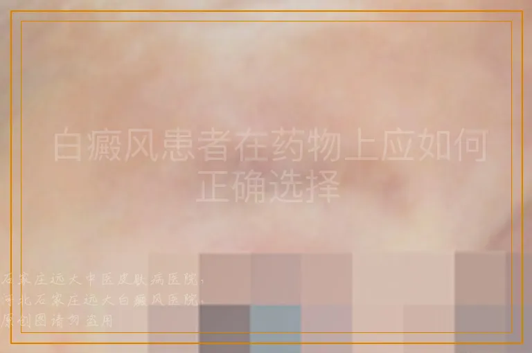 白癜风患者在药物上应如何正确选择