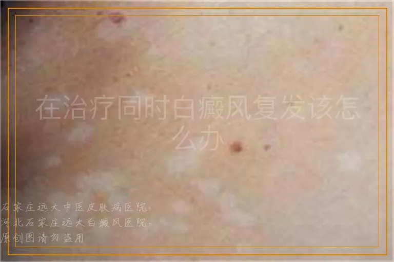 在治疗同时白癜风复发该怎么办