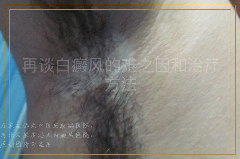 再谈白癜风的难之因和治疗方法