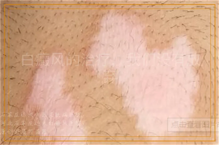 白癜风的治疗，我们没有放弃