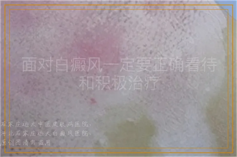 面对白癜风一定要正确看待和积极治疗