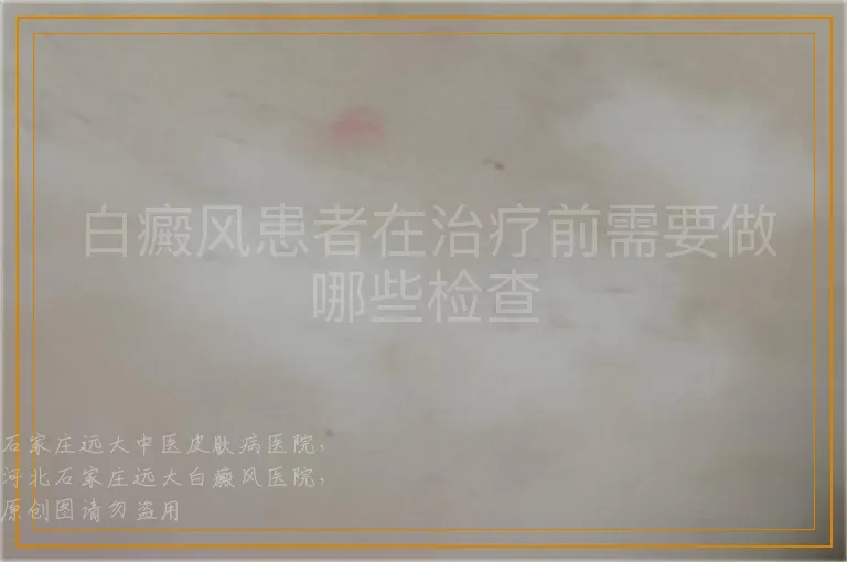 白癜风患者在治疗前需要做哪些检查