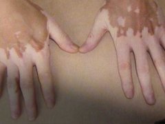 街头流浪行乞,原因竟是白癜风